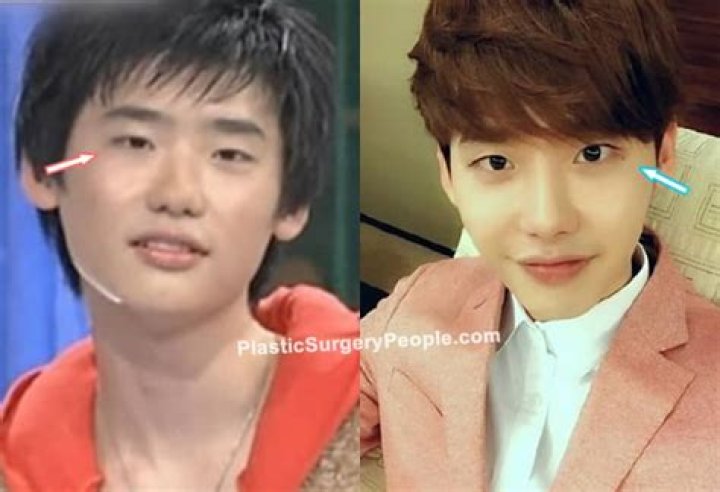 How Does Lee Jong Suk Before Plastic Surgery | What Is Wrong With His Face